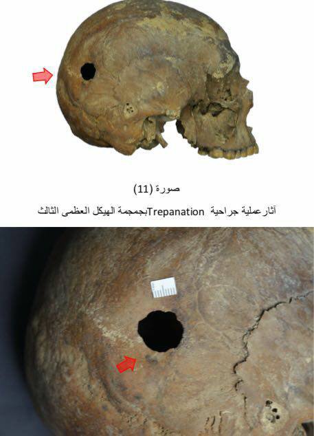 Отверстие в черепе могло появиться в результате трепанации
