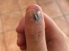 Студентці Кортні Уітхорн з Австралії ампутували великий палець через рідкісну форму раку шкіри. Почалося все зі звички гризти нігті