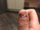 Студентке Кортни Уитхорн из Австралии ампутировали большой палец через редкую форму рака кожи. Началось все с привычки грызть ногти