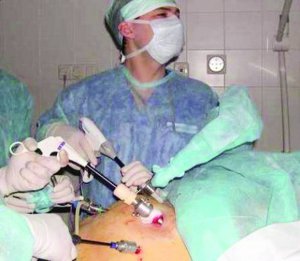 Операція по видаленню апендициту триває 30 хвилин. Хірург робить маленькі надрізи, через які вводить в черевну порожнину інструменти та відео­камеру