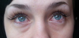 Людям із хворобами очей нарощення вій протипоказане. Якщо хоч раз виникли ускладнення, від процедури слід відмовитися