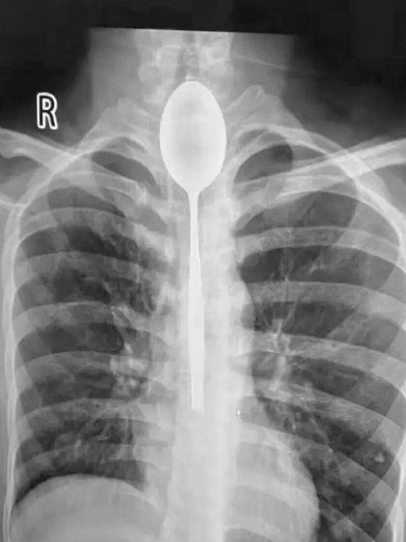 Рентгенівське зображення, що показує металеву ложку у стравоході пацієнта
