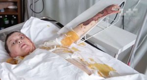 31 июля Екатерину Гандзюк облили концентрированной серной кислотой. Получила быльше 30% ожогов тела. Перенесла быльше 10 операций. Умерла от полиорганной недостаточности и ожоговой болезни