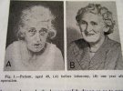 Фотограф показал пациентов до и после лоботомии