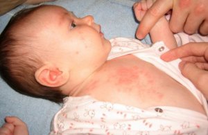 Кір: 8-місячна дитина підхопила вірус у матері