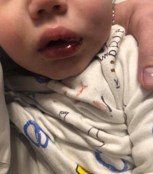 Фото 13-місячного сина з розбитою губою і синцями поширила в соцмережі Марія Литовченко з Одеси. Каже, що дитину побила няня 