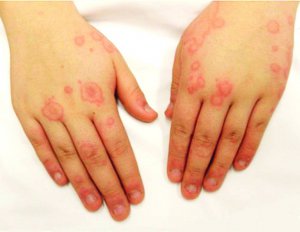 Алергію на холод лікують антигістамінними препаратами