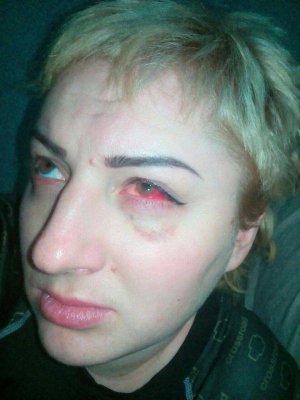Світлана Щербенко з Умані на Черкащині написала заяву до поліції на косметолога. Після відвідин майстра перестала бачити на ліве око, каже