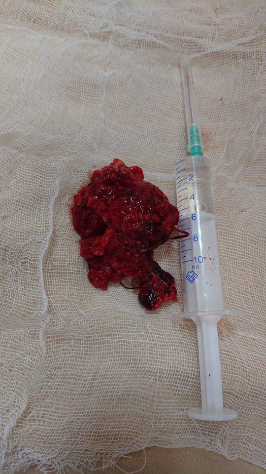 В Украине больному раком щитовидной железы пациенту сделали уникальную операцию. Фото: Facebook