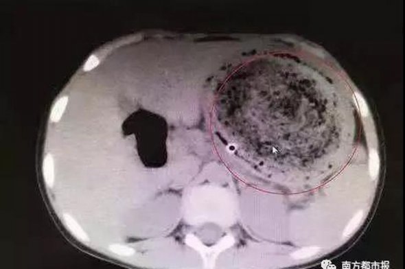 Наличие волосяного кома в желудке девочки обнаружили, проведя компьютерную томографию. ФОТО: mirror.co.uk 