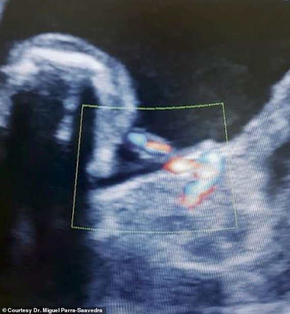 Це перший випадок, коли аномалію fetus in fetu виявили не після народження дитини, а під час вагітності.  