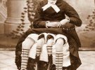 Дівчина Мертл Корбін, яка народилася в 1868 році з подвоєним тазом і чотирма ногами.  Кожна з її маленьких «внутрішніх» ніг становила пару з однією з нормальних ніг.  За словами Корбін, вона могла рухати своїми внутрішніми ногами, але вони були занадто слабкими, тому ходити на них було неможливо.  Протягом свого життя працювала актрисою в бродячих цирках.  У 19 років Мертл Корбін вийшла заміж за доктора Клінтона Бікнелла, від якого народила п'ятьох здорових дітей: чотирьох дочок і сина, яких вона виносила, використовуючи свої дві репродуктивні системи.  Померла у віці 59 років.
