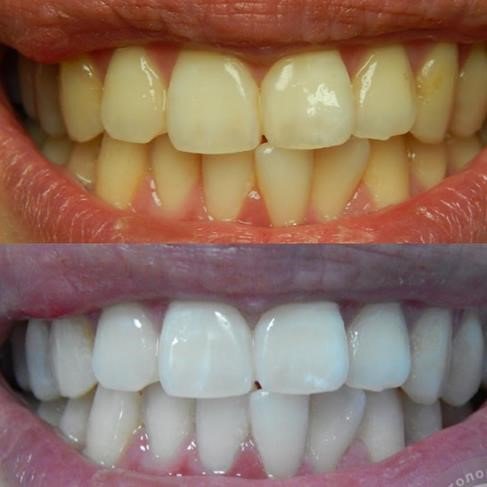 Качественное отбеливание зубов в клинике - это выгодная инвестиция в собственную внешность