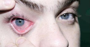 Симптомом кобри називають стан, коли судина розі­рвалася всередині ока і пошкодила очне дно