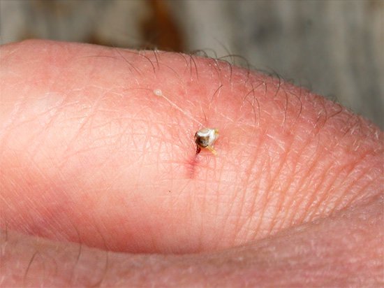 В теплое время года внимательно следите за кожей, особенно за местами укусов насекомых