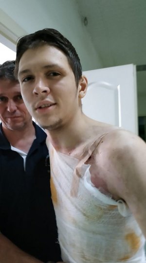 Після удару струмом Сергієві Спасову пересадили шкіру на нозі, руці й грудній клітці. Місяць не дозволяли вставати з ліжка
