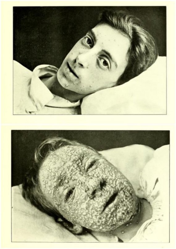Людина інфікована натуральною віспою, початок XX ст.
