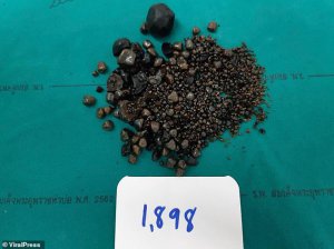 Вилучені з організму жінки камені.