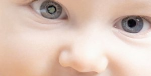Щорічно в Україні народжуються 250–290 дітей із катарактою