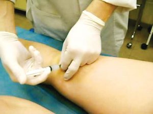 Під час процедури ортоплазми в суглоб вводять збагачену тромбоцитами плазму. Курс складається з трьох–п’яти ін'єкцій 