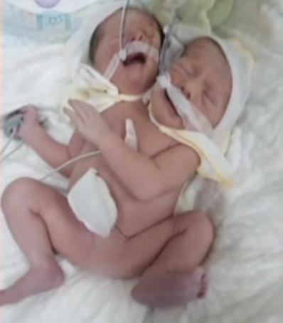 Сіамські близнючки народились в Чернівцях