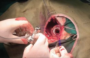 Кардіохірург Борис Тодуров встановлює штучне міні-серце  у груди пацієнта В’ячеслава Вожженка