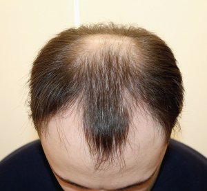 Після 30 років шкіра голови грубішає, погіршується кровопостачання. Через це виникає облисіння. У чоловіків перестає рости волосся на лобі, скронях і маківці