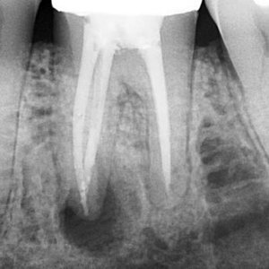 Гранульома проявляється різким або ниючим болем над зубом. У складних випадках виникає опухлість і нагноєння
