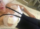 Анжелика Исаксен обратилась к турецкой безымянной пластической клиники, чтобы скорректировать тело после вторых родов и подготовиться к соревнованиям по бикини