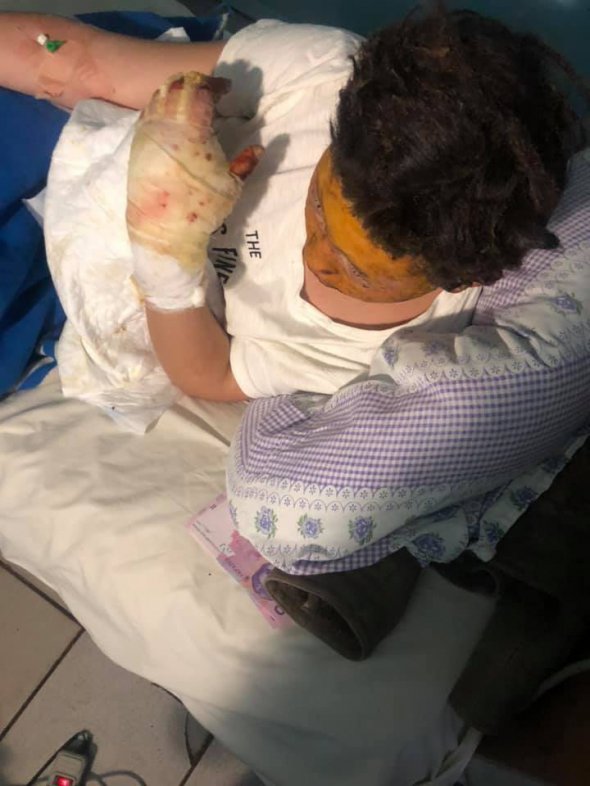 У 16-річної дівчини обпечені руки, обличчя і дихальні шляхи