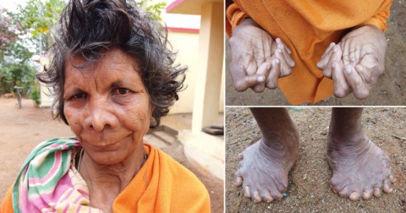 Кумари Наяк страдает полидактилизмом, когда количество пальцев на конечностях больше нормы