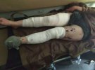 На линии разграничения в Донбассе 35-летняя женщина подорвалась на минном поле боевиков