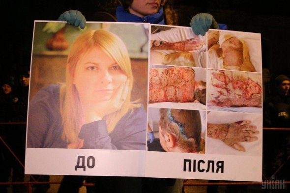 Катерина Гандзюк отримала хімічні опіки понад 30% тіла: голови, обличчя, лівої руки й ноги, передньої частини грудної клітки, лівого ока. Вона перенесла 14 операцій
