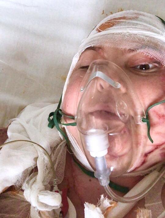 На Екатерину Гандзюк напали возле ее дома - злоумышленник вылил на нее литр серной кислоты. Последнее селфи из столичной больницы Екатерина сделала 1 ноября 2018 года 