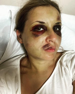Після нападу незнайомця в поїзді Маріуполь—Київ Анастасія Лугова перебуває на стаціонарному лікуванні. В неї зламана щелепа, струс мозку, гематоми на обличчі