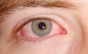 При кон’юнктивіті в оці виникає почервоніння, свербіж, біль. Знижується чіткість зору