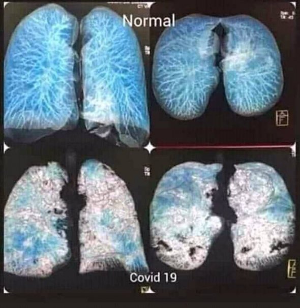 Українські медики показали фото легень людини, яка захворіла коронавірусною інфекцією. У верхній частині фотографії показані легені в нормальному стані, знизу – уражені Covid-19