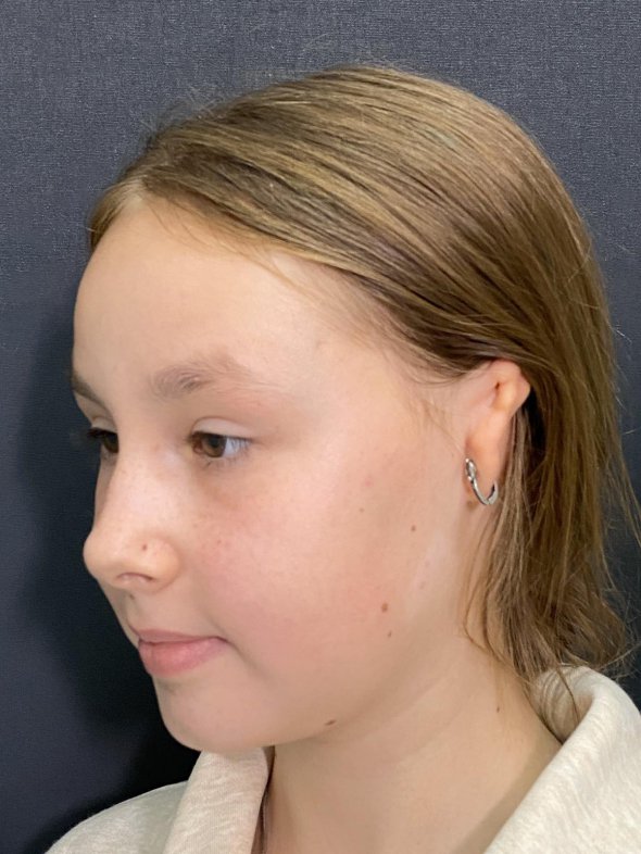 Дівчинка мала вроджене недорозвине вухо.