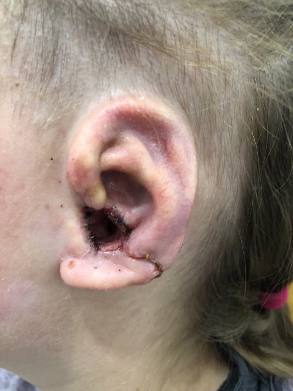 Девочка имела врожденное недоразвитое ухо. 
