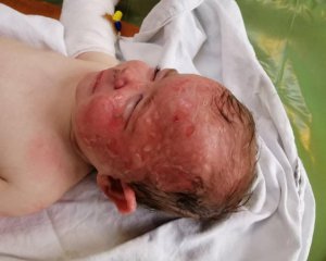Спалахнули розетка, шнур і подушка: 9-місячна дівчинка отримала страшні опіки