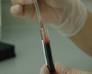 Назвали основные симптомы образования тромбов