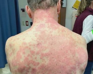 У мужчины после прививки от коронавируса начала слезать кожа: что сказали врачи