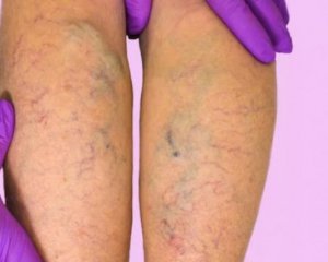 Коронавирус дает осложнения на ноги;первые симптомы