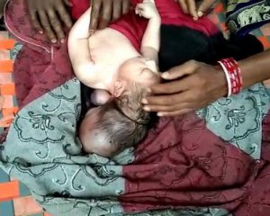 Жінка народила дитину з трьома головами