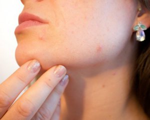 Косметолог назвала основные причины сыпи на лице