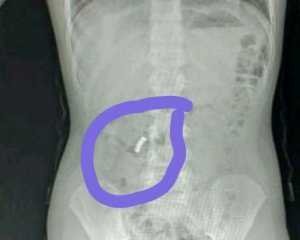 В Одеській обалсті дитина проковтнула 4 магніти