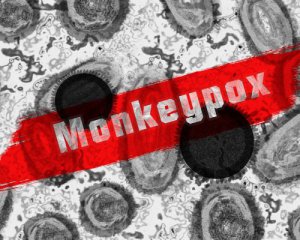 У МОЗ розповіли, чи загрожує Україні мавпяча віспа