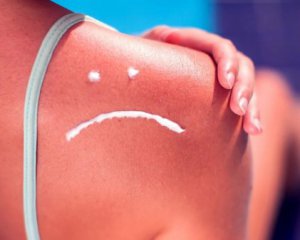 Не сдирайте пузыри: 8 средств, которыми опасно смазывать кожу после солнечного ожога