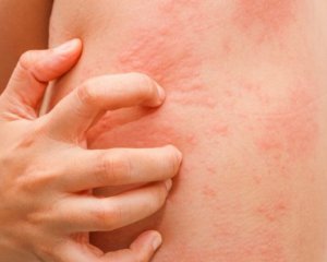 Аллергия на холод: врач описала симптомы и группы риска