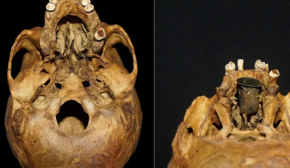 У черепі знайшли древній протез